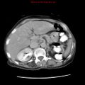 Adenocarcinoma of the colon (Radiopaedia 8191-9039 Axial renal excretory phase 10).jpg