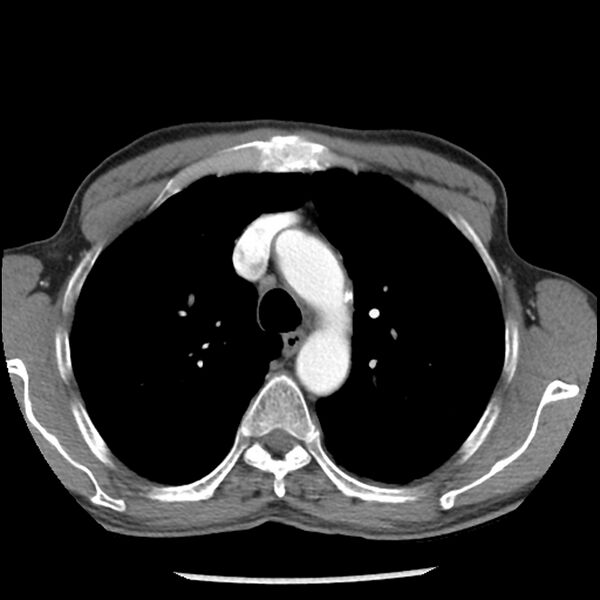 File:Adenocarcinoma of the lung - micropapillary predominant (Radiopaedia 42446-45563 Axial C+ portal venous phase 21).jpg