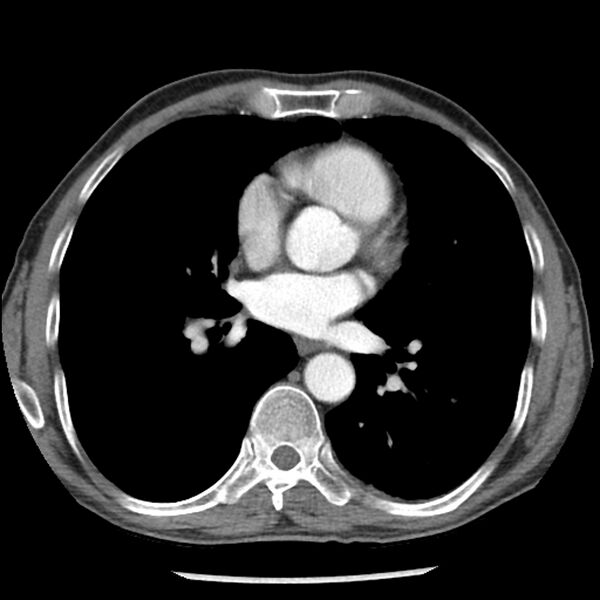 File:Adenocarcinoma of the lung - micropapillary predominant (Radiopaedia 42446-45563 Axial C+ portal venous phase 42).jpg
