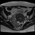 Adenomyosis and endometriotic cysts (Radiopaedia 82300-96367 Axial T2 16).jpg