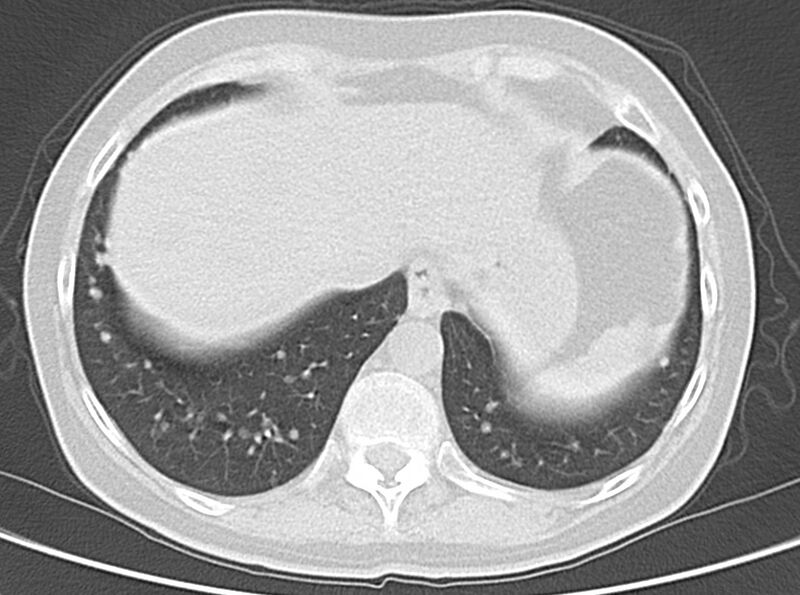 File:Adenosquamous lung carcinoma (Radiopaedia 22035-22030 lung window 50).jpg