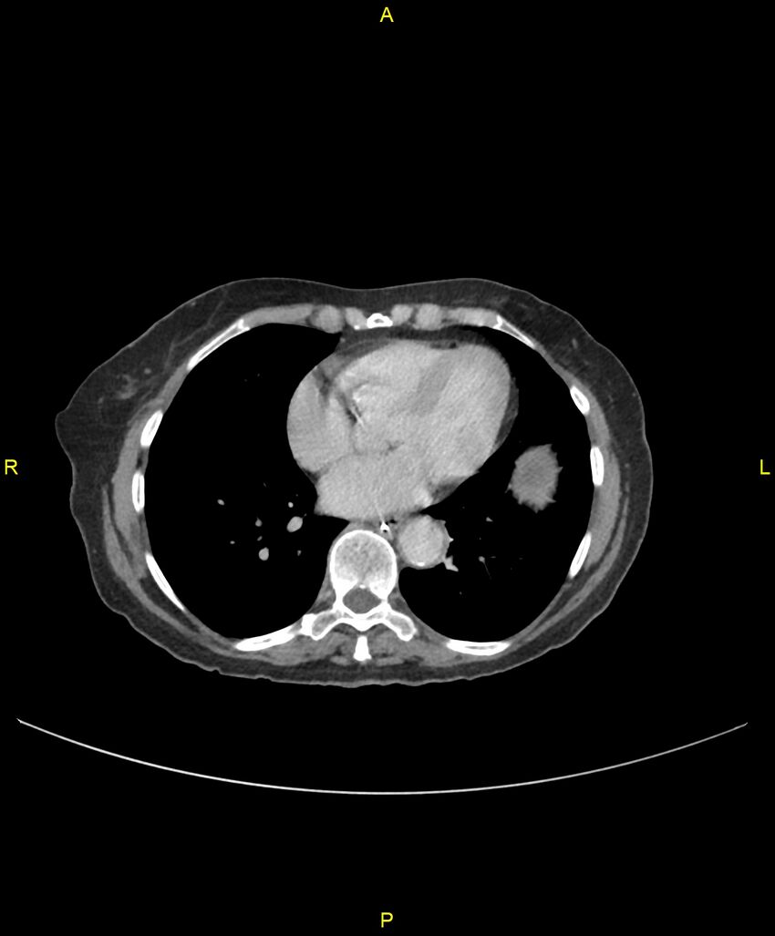 Adhesional small bowel obstruction (Radiopaedia 85402-101024 Axial C+ portal venous phase 1).jpg