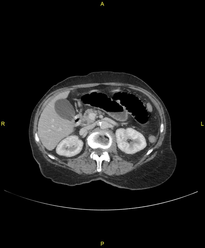 Adhesional small bowel obstruction (Radiopaedia 85402-101024 Axial C+ portal venous phase 100).jpg
