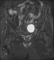 Adnexal multilocular cyst (O-RADS US 3- O-RADS MRI 3) (Radiopaedia 87426-103754 Coronal T2 fat sat 15).jpg