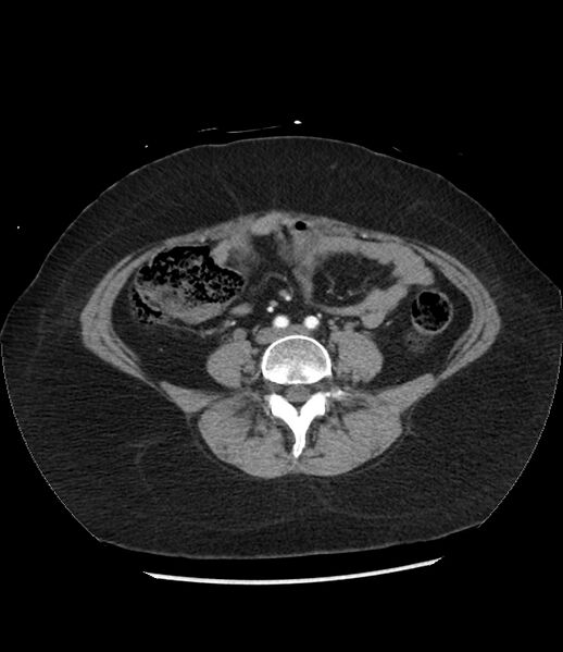 File:Adrenal cortical carcinoma with IVC invasion and thrombosis (Radiopaedia 34307-35597 Axial C+ arterial phase 56).jpg