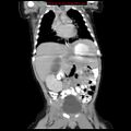 Adrenal hemorrhage (Radiopaedia 9390-10077 Coronal C+ portal venous phase 4).jpg