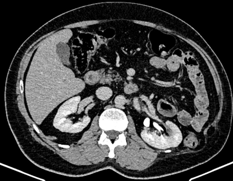 File:Adrenal metastases (Radiopaedia 73082-83791 Axial C+ delayed 135).jpg