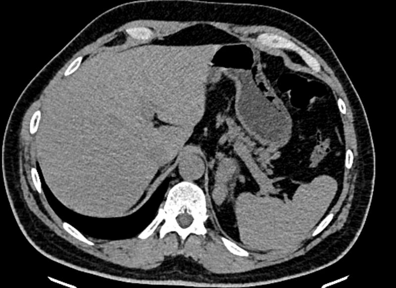 File:Adrenal metastases (Radiopaedia 73082-83791 Axial non-contrast 36).jpg