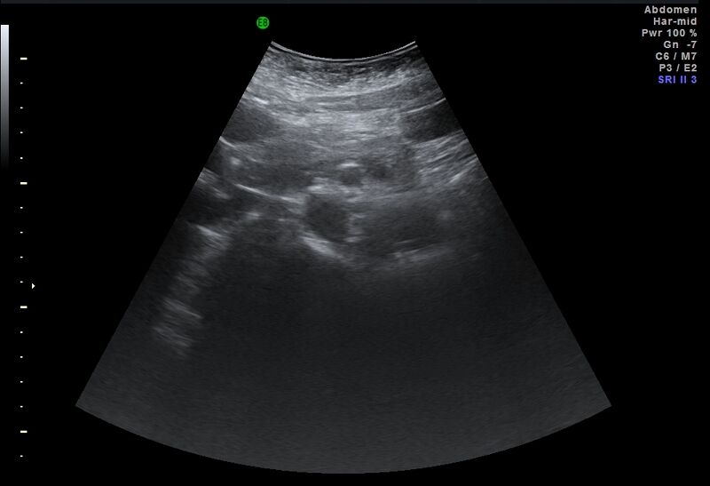 File:Adrenal myelolipoma - bilateral (Radiopaedia 74805-85811 Abdominal ultrasound 13).jpg