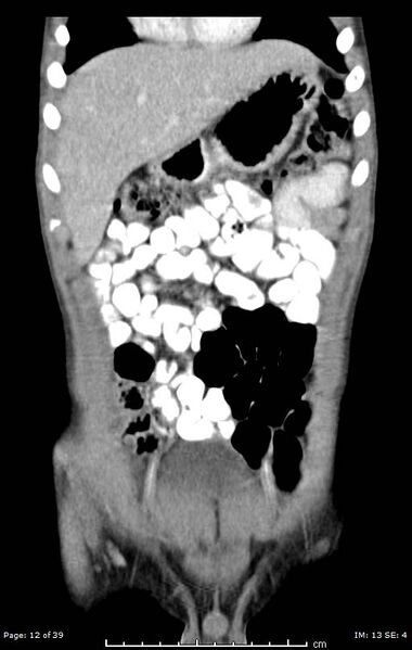 File:Agenesis of the gallbladder (Radiopaedia 55454-61905 A 12).jpg