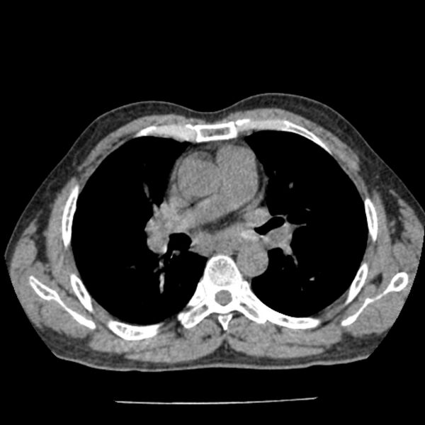 File:Airway foreign body in adult (Radiopaedia 85907-101779 Axial liver window 75).jpg
