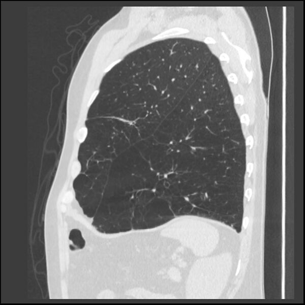 File:Alpha-1-antitrypsin deficiency (Radiopaedia 40993-43722 Sagittal lung window 58).jpg