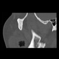 Ameloblastic fibro-odontoma (Radiopaedia 18843-18780 bone window 15).jpg