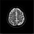 Amnestic syndrome secondary to hypoxic brain injury (Radiopaedia 24743-25004 DWI 57).jpg