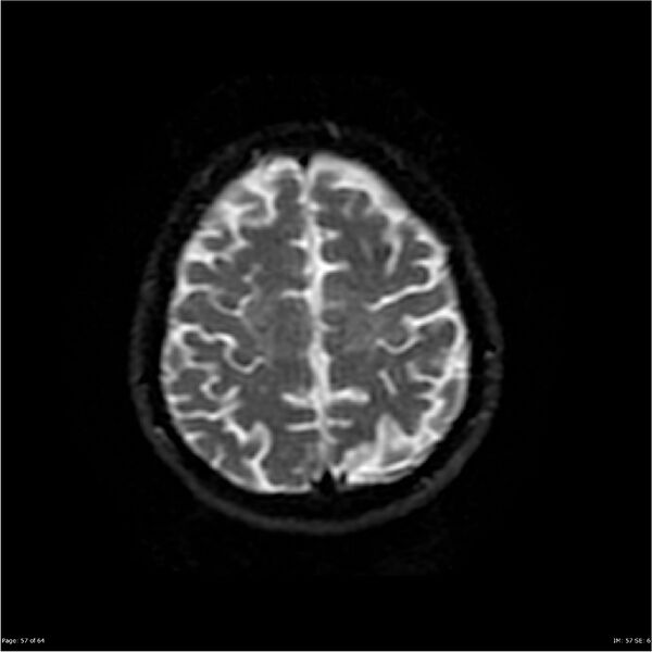 File:Amnestic syndrome secondary to hypoxic brain injury (Radiopaedia 24743-25004 DWI 57).jpg