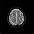Amnestic syndrome secondary to hypoxic brain injury (Radiopaedia 24743-25004 DWI 58).jpg