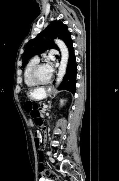 File:Ampullary adenocarcinoma (Radiopaedia 86093-102033 E 59).jpg