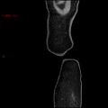 Ampullary carcinoma (Radiopaedia 56396-63056 D 3).jpg