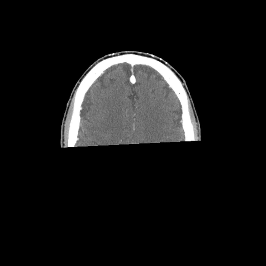 Anaplastic thyroid carcinoma (Radiopaedia 79087-92034 B 158).jpg