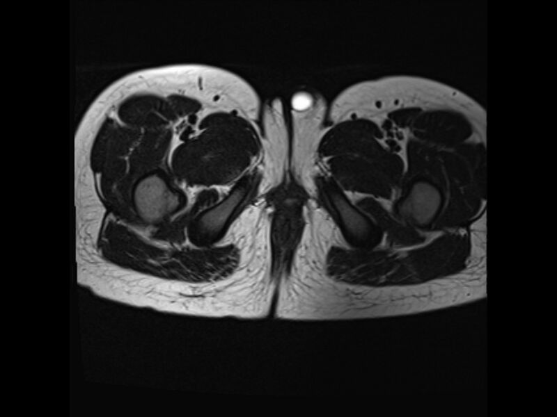 File:Androgen insensitivity syndrome (Radiopaedia 42046-45081 Axial T2 22).jpg