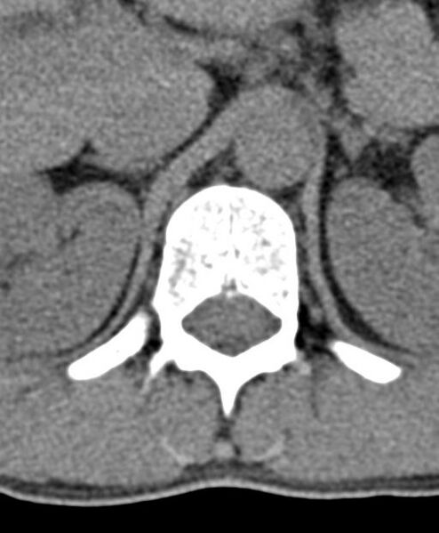 File:Aneurysmal bone cyst T11 (Radiopaedia 29294-29721 Axial non-contrast 54).jpg