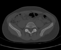 Aneurysmal bone cyst of ischium (Radiopaedia 25957-26094 Axial bone window 13).png