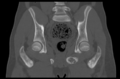 Aneurysmal bone cyst of ischium (Radiopaedia 25957-26094 Coronal bone window 24).png