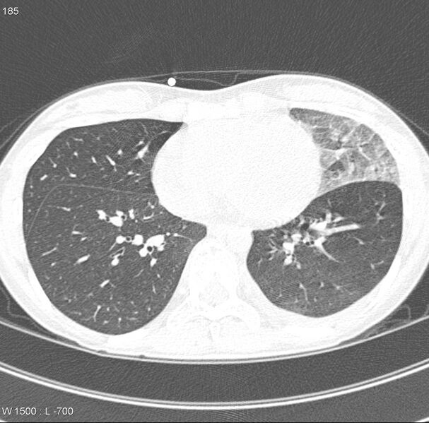 File:Angioinvasive aspergillosis (Radiopaedia 8651-9466 Axial lung window 11).jpg
