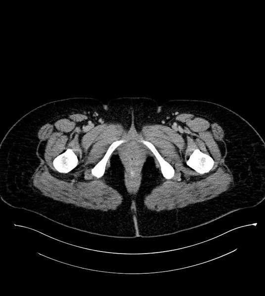 File:Anterior abdominal wall CSF pseudocyst (CSFoma) (Radiopaedia 79453-92571 A 97).jpg