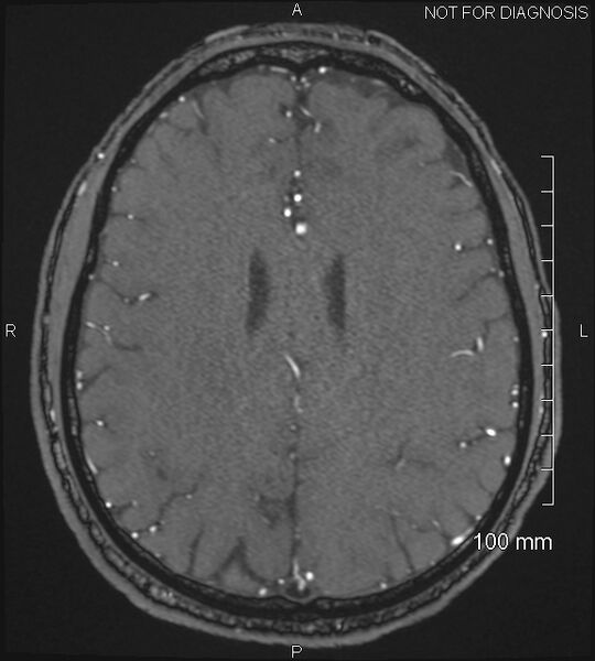 File:Anterior cerebral artery aneurysm (Radiopaedia 80683-94127 Axial MRA 168).jpg