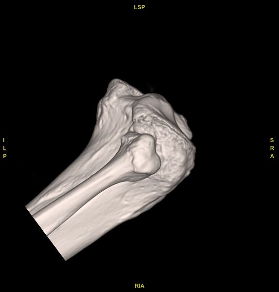 File:Anterior cruciate ligament avulsion fracture (Radiopaedia 58939-66194 VRT 7).jpg