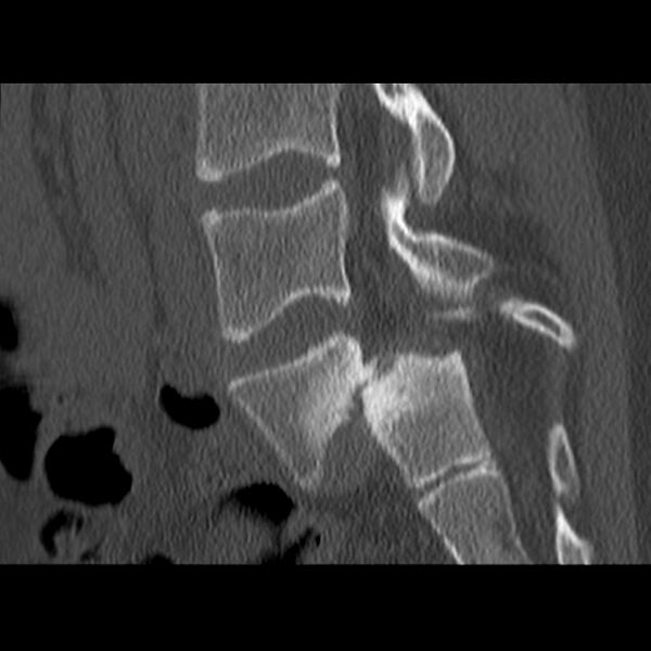 File:Anterolisthesis (Radiopaedia 22226-22263 Sagittal bone window 13).jpg