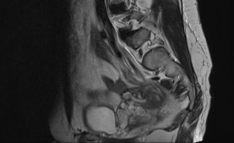 File:Anteverted retroflexed uterus (Radiopaedia 84697).jpg