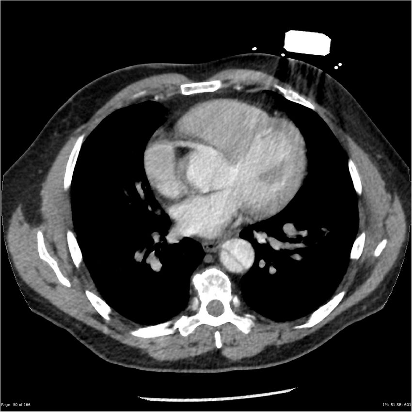 Aortic dissection- Stanford A (Radiopaedia 37759-39664 A 41).jpg