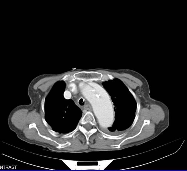 File:Aortic dissection - Stanford type A (Radiopaedia 20760-20675 C 1).jpg