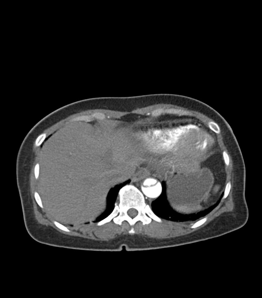 Aortic dissection with renal ischemia (Radiopaedia 76573-88338 A 54).jpg