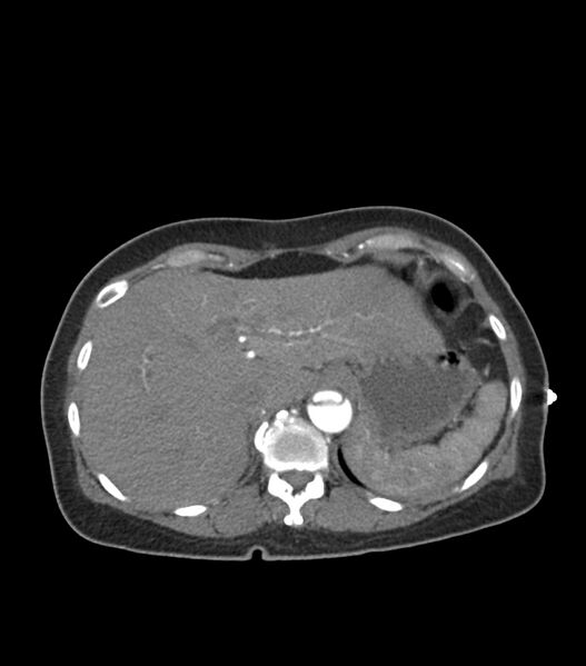 File:Aortic dissection with renal ischemia (Radiopaedia 76573-88338 A 57).jpg
