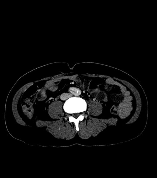 File:Aortic dissection with renal ischemia (Radiopaedia 76573-88338 B 47).jpg