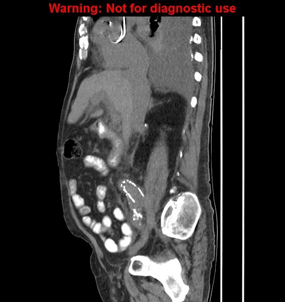 File:Aortic graft infection (Radiopaedia 44979-48907 C 43).jpg
