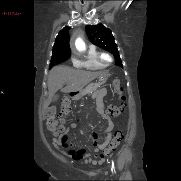 File:Aortic intramural hematoma (Radiopaedia 27746-28001 B 10).jpg