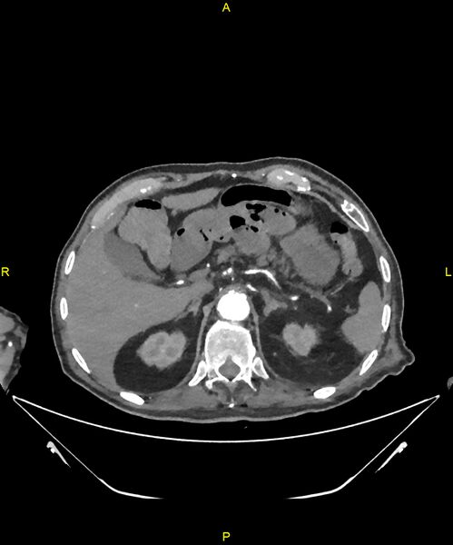 File:Aortoenteric fistula (Radiopaedia 84308-99603 B 73).jpg