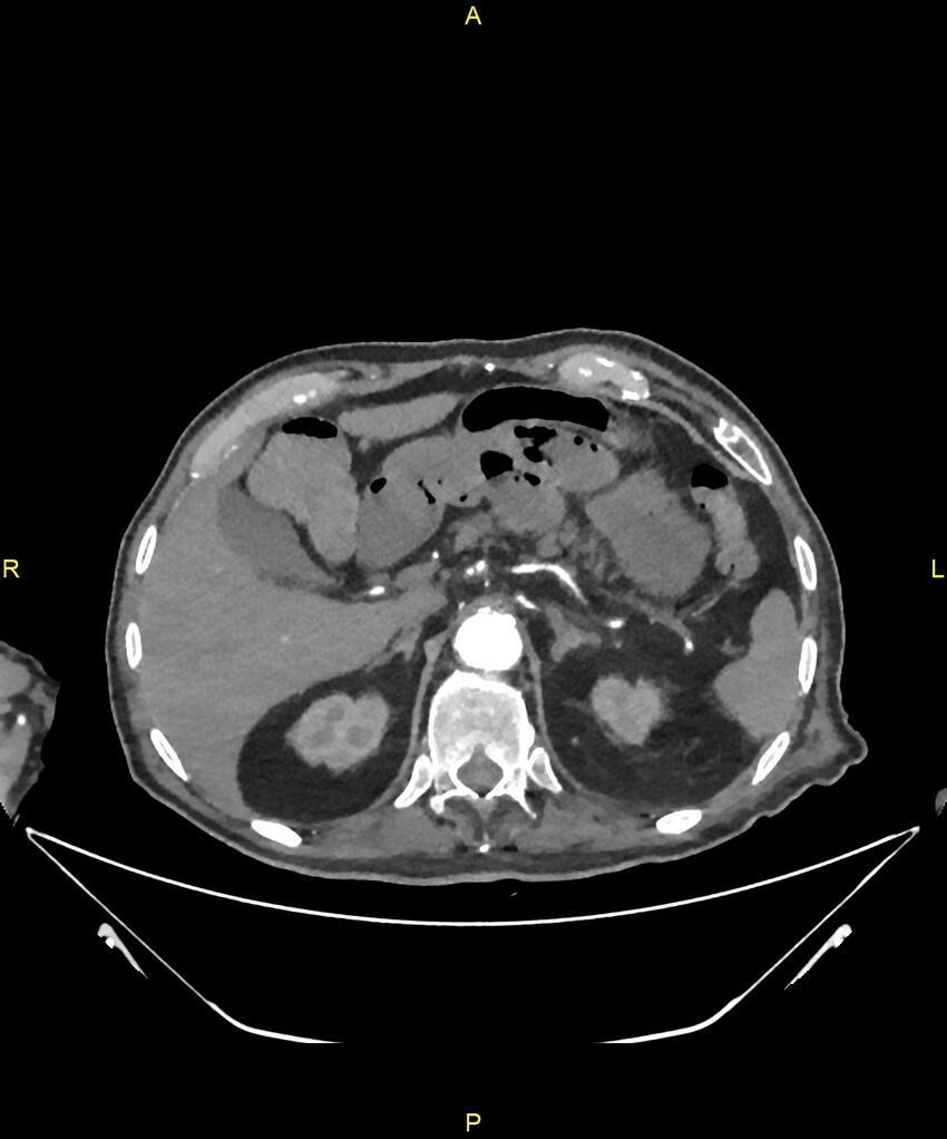 Aortoenteric fistula (Radiopaedia 84308-99603 B 73).jpg