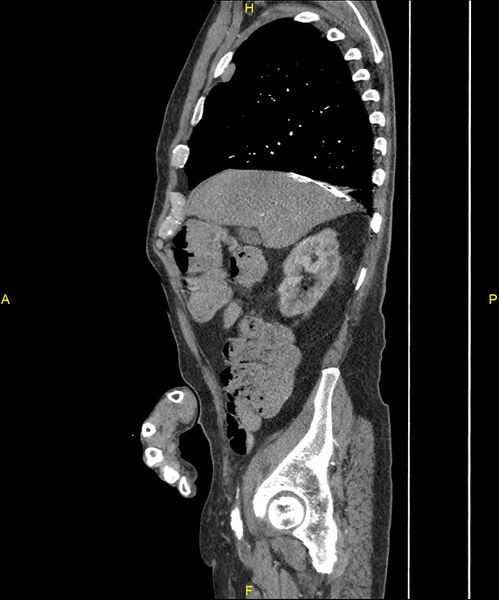 File:Aortoenteric fistula (Radiopaedia 84308-99603 C 92).jpg