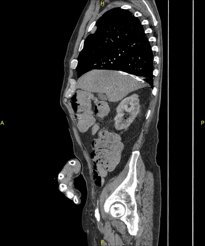 Aortoenteric fistula (Radiopaedia 84308-99603 C 92).jpg