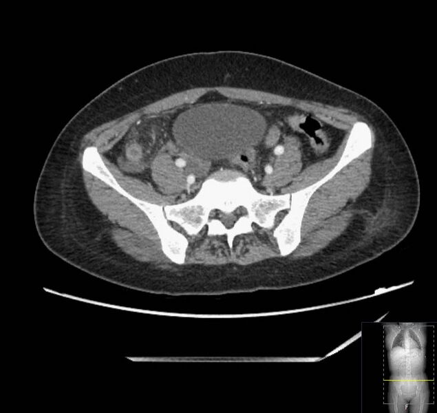 File:Appendicitis (CT angiogram) (Radiopaedia 154713-127660 Axial 9).jpg