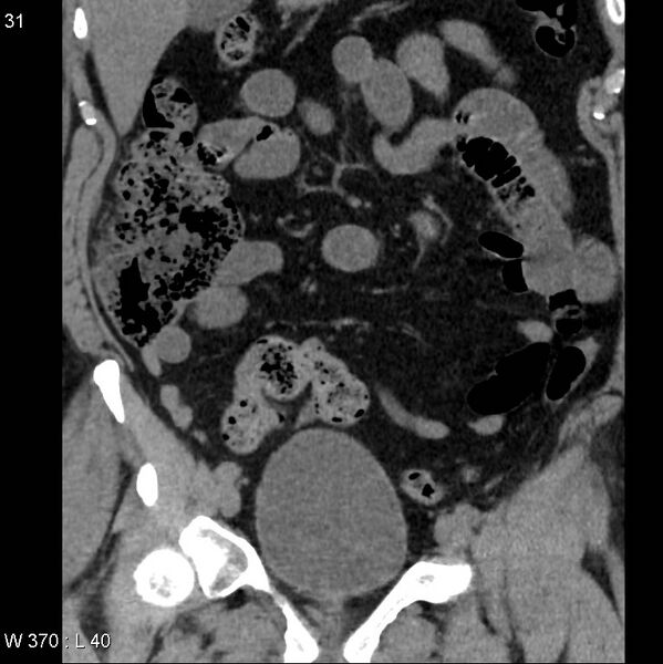 File:Appendicitis (Radiopaedia 12510-12733 Coronal non-contrast 1).jpg