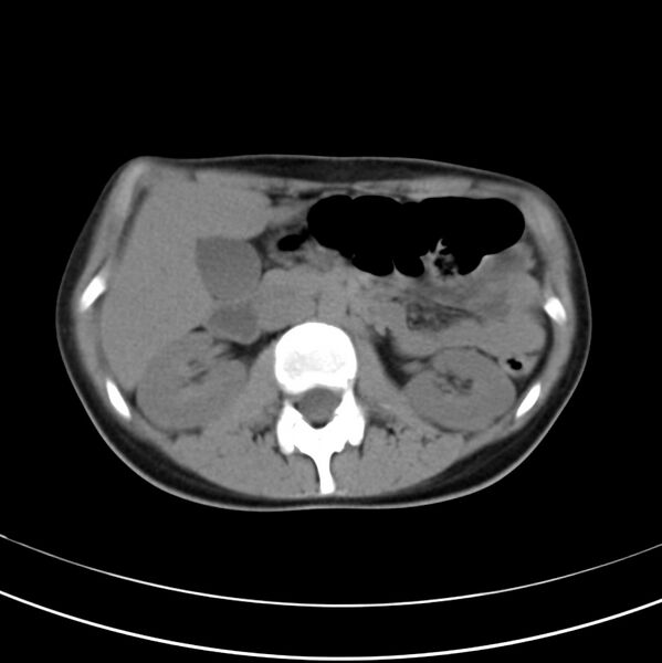 File:Appendicitis and incidental bicornuate uterus (Radiopaedia 22833-22853 Axial non-contrast 17).jpg