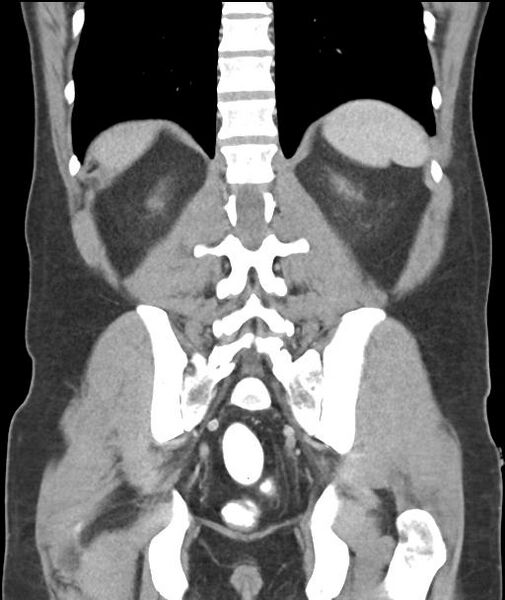 File:Appendicitis with cecal bar sign (Radiopaedia 31878-32830 A 46).jpg