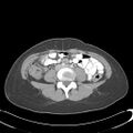 Appendicitis with minimal stranding but appendicolith (Radiopaedia 29035-29397 A 51).jpg