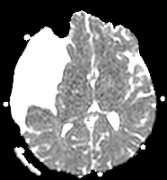 File:Arachnoid cyst- extremely large (Radiopaedia 68741-78451 Axial ADC 13).jpg